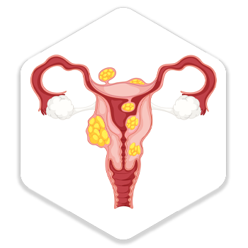 uterine fibroids